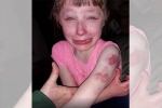 lilly special needs child, Wisconsin girl, 10 year old special needs child brutally bitten on arm while returning home in school bus, Special needs