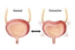 Overactive Bladder breaking news, Overactive Bladder prevention, here are some warning signs of an overactive bladder, Overactive bladder