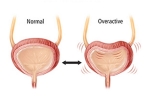 Overactive Bladder updates, Overactive Bladder, here are some warning signs of an overactive bladder, Coming out