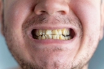 Nicotine stains bad, Nicotine stains teeth, are nicotine stains on your teeth irreversible, Smile
