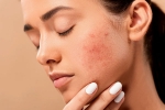 acne, skin care, 10 ways to get rid of pimples at home, Unsc