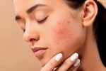 skin care products, skin, 10 ways to get rid of pimples at home, The nose