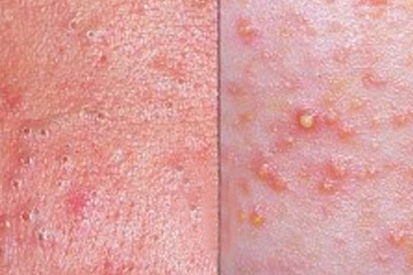 Difference between blackheads and whiteheads