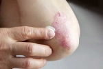 Skin disorders treatment, Skin disorders health problems, five common skin disorders and their symptoms, Skin disorders