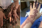 how long does black henna reaction last, black henna side effects, henna tattoo cause aussie woman to almost lose her hand, Hair dye