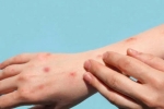Monkeypox new cases, Monkeypox in bisexual men, study says that the symptoms of monkeypox are different from earlier, Monkeypox